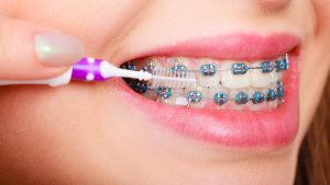 Entretenir vos appareils orthodontiques