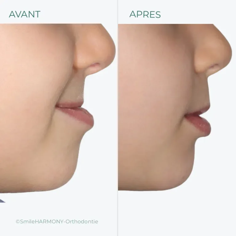 correction par traitement orthodontique précoce d'une malocclusion de classe 3 avec décalage des mâchoires.