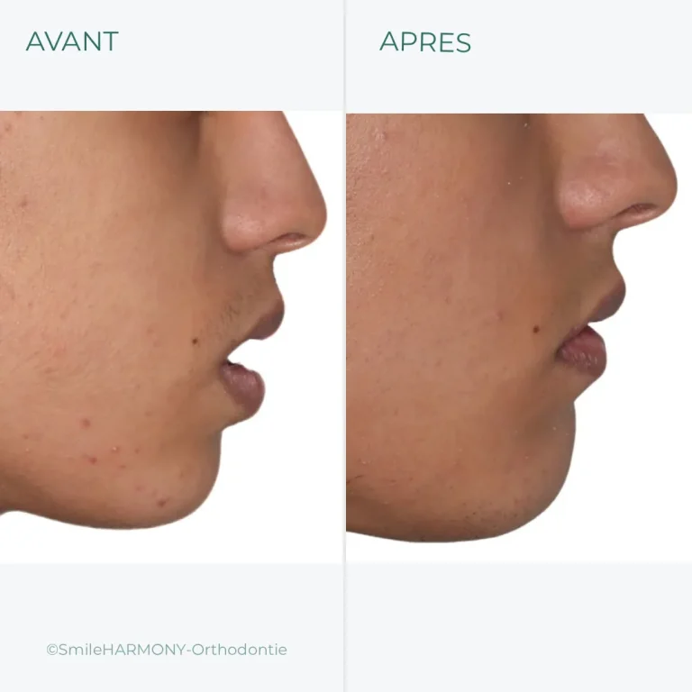 Harmonisation de profil d'adolescent, orthodontie guidée par le visage.
