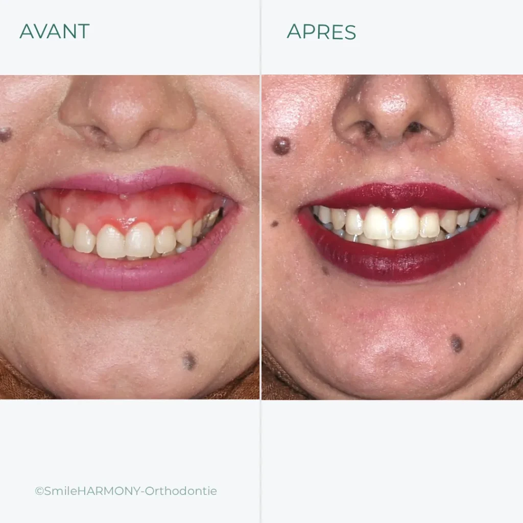transformation d'un sourire gingival avant-après