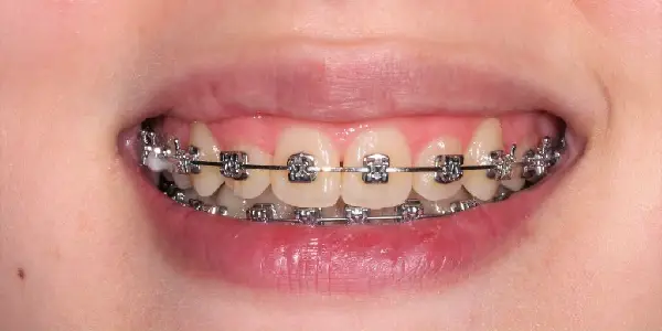 sourire adolescente avec appareil dentaire type brackets autoligaturants à SmileHARMONY aalger