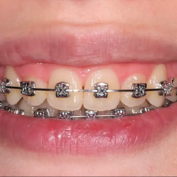 sourire adolescente avec appareil dentaire type brackets autoligaturants à SmileHARMONY aalger