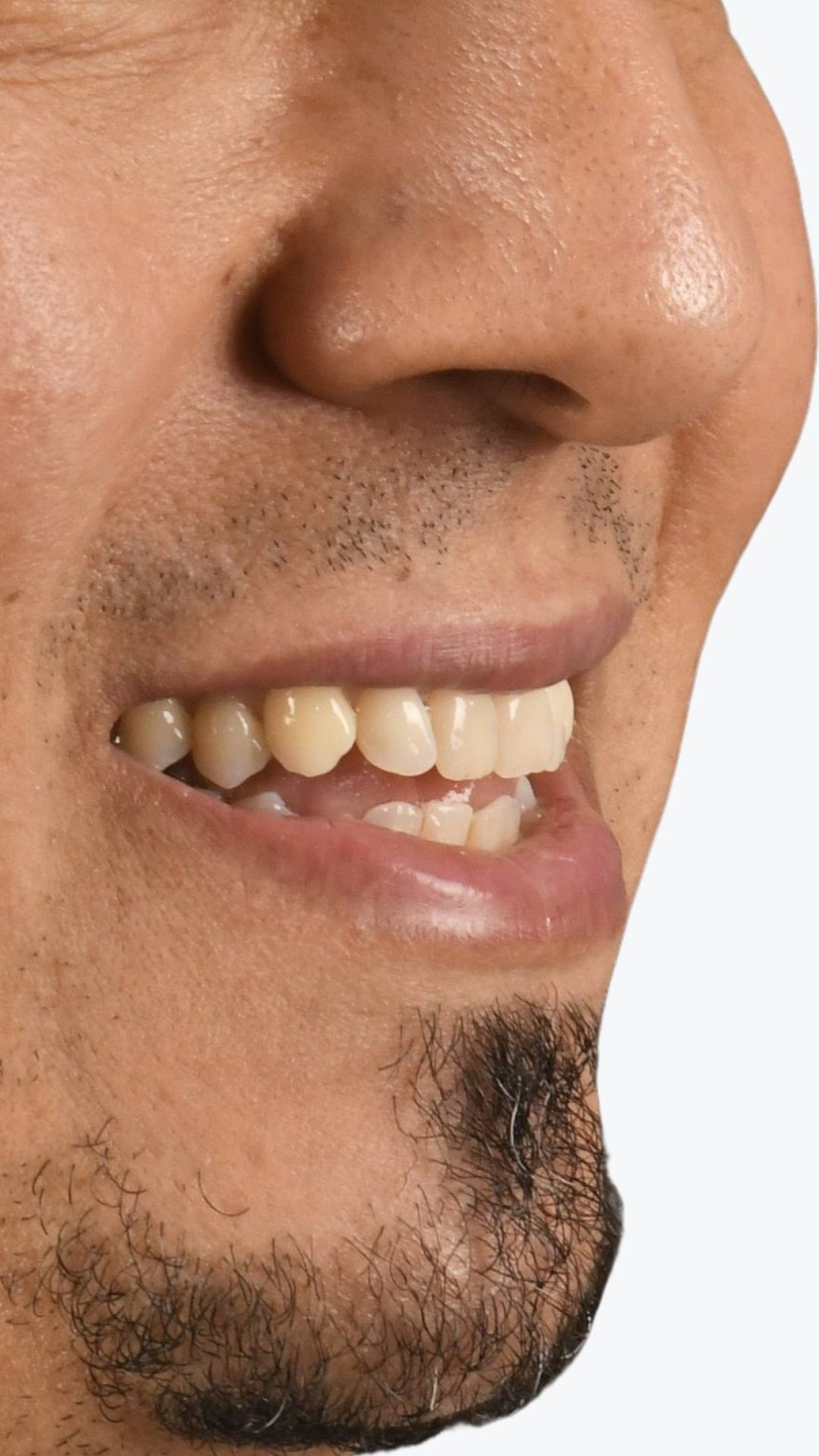 sourire d'un patient adulte avant son bilan orthodontique à SmileHARMONY