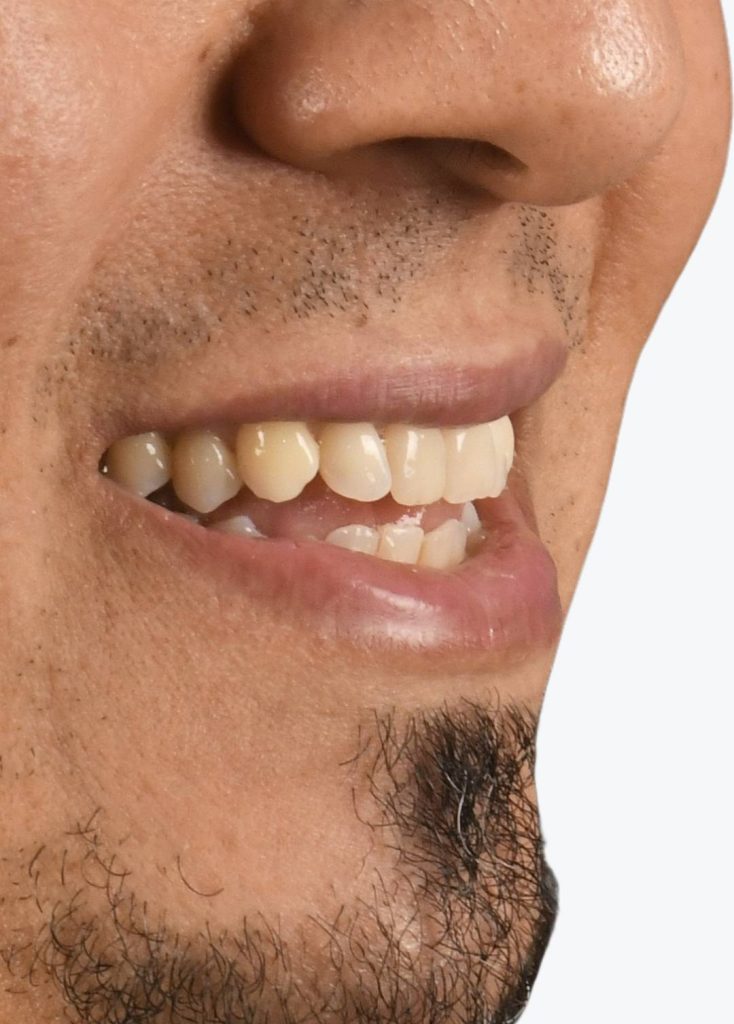 sourire-adulte-béance-dentaire-avant-traitement-orthodontique-dr-benahmed-SmileHARMONY