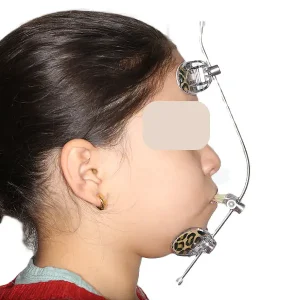 masque facial d'orthodontie interceptive à SmileHARMONY alger