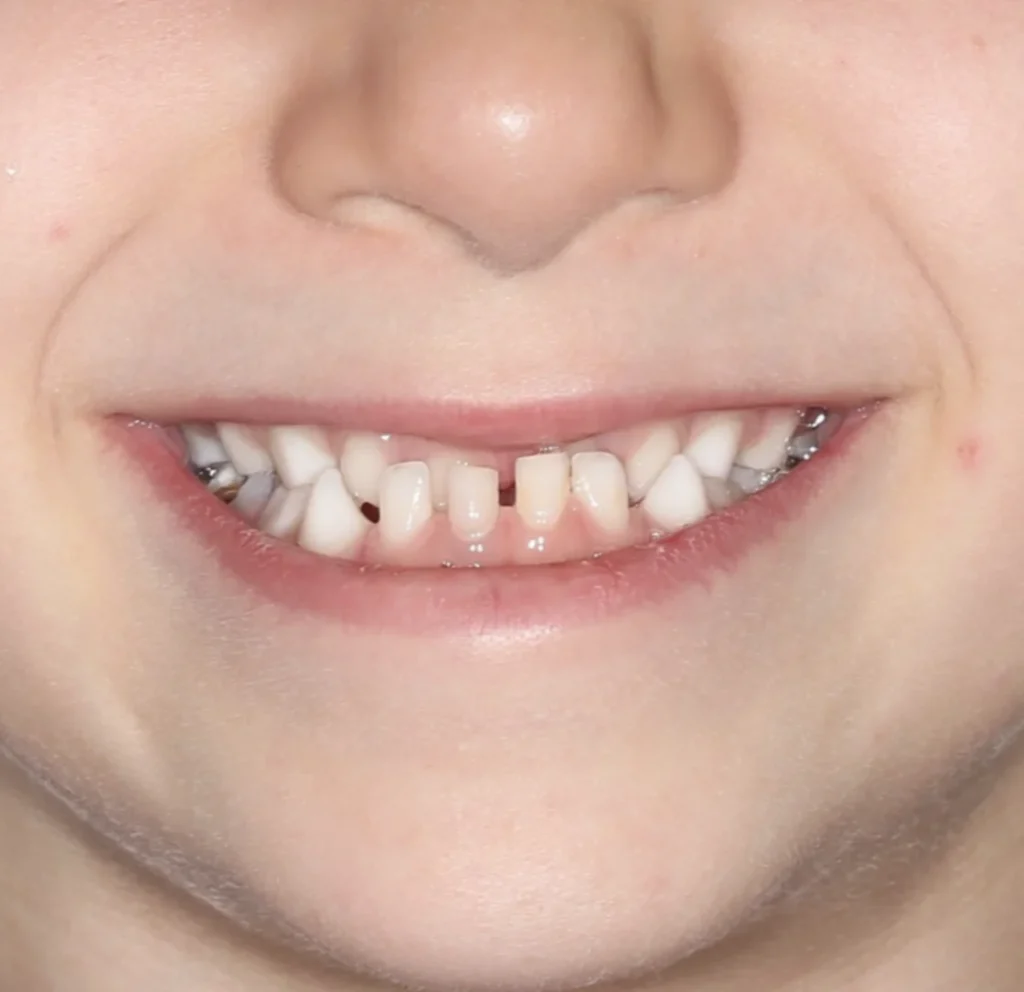 sourire-enfant-malocclusion-clsse-3-avant-traitement-orthodontie-alger-dr-benahmed-SmileHARMONY