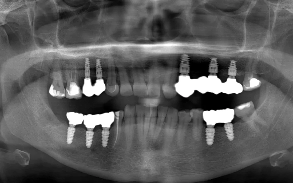 Radiographie d'implants dentaires en bouche