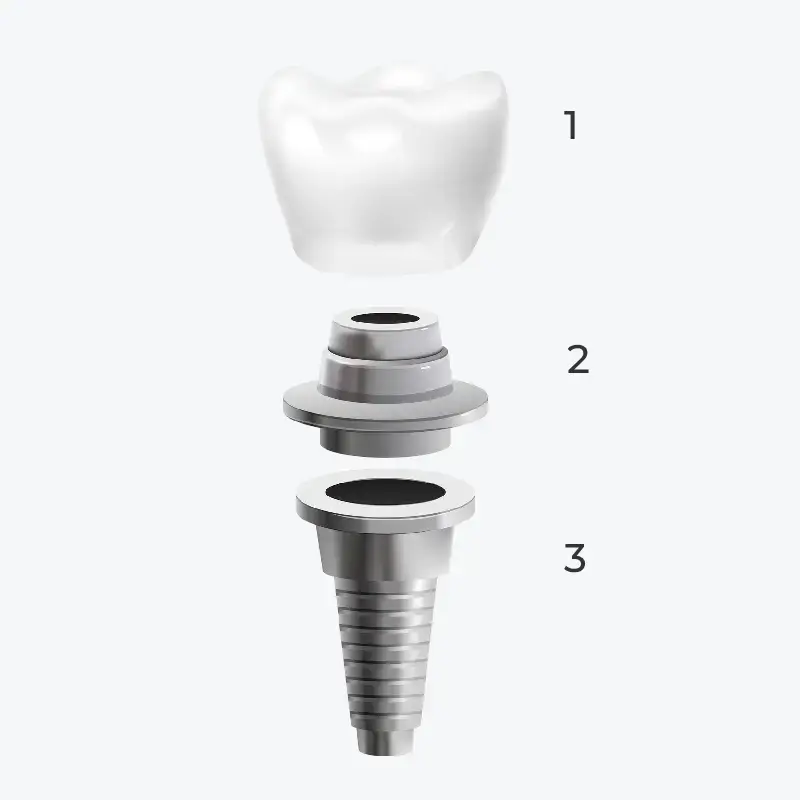 composition d'un implant dentaire