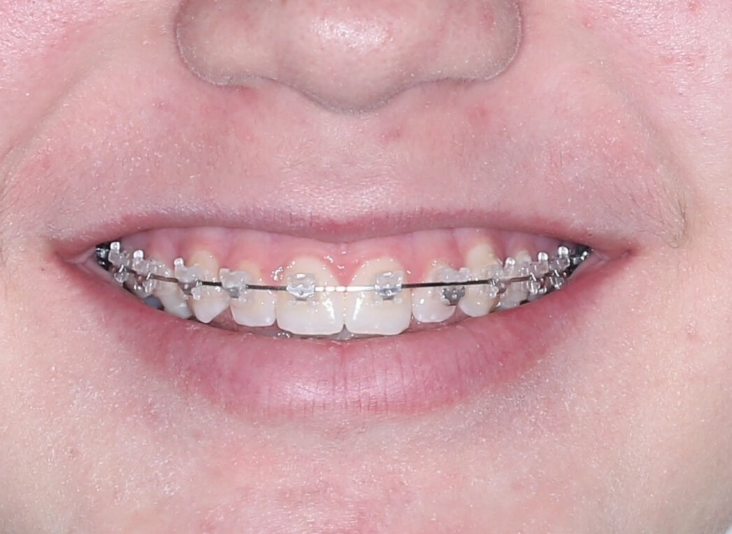 Sourire adolescente avec brackets céramiques