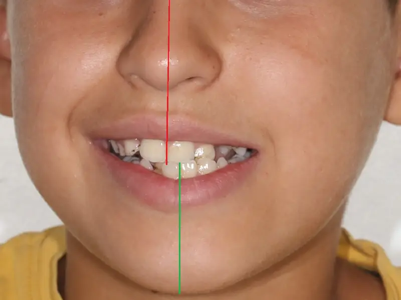 asymétrie faciale chez un jeune enfant