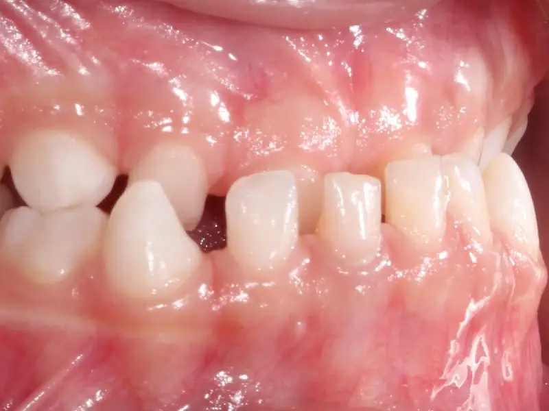 image endobuccale d'une malocclusion de classe III chez un jeune enfant