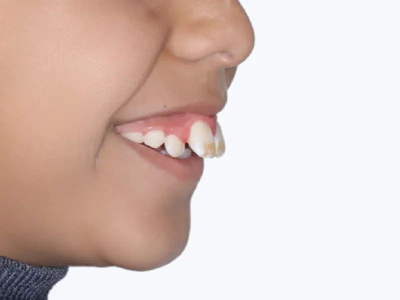 dents projetées en avant chez un jeune enfant