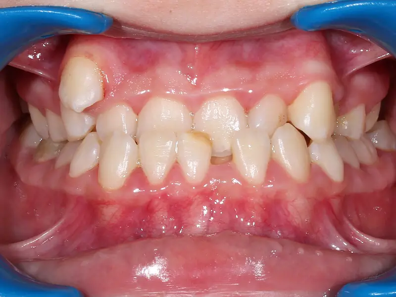 malocclusion de classe 3 sevère chez un adolescent