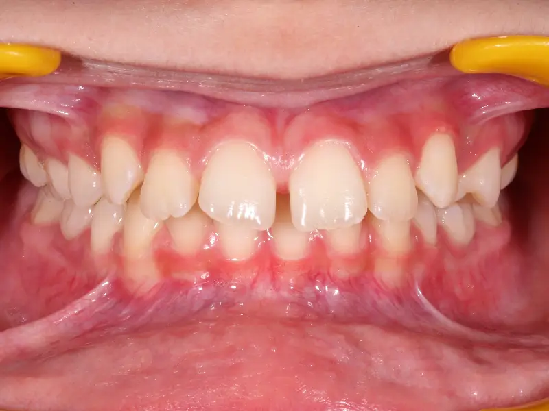 malocclusion de classe 2 chez une adolescente