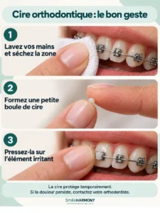 infographie en français illustrant l'utilisation de la cire orthodontique