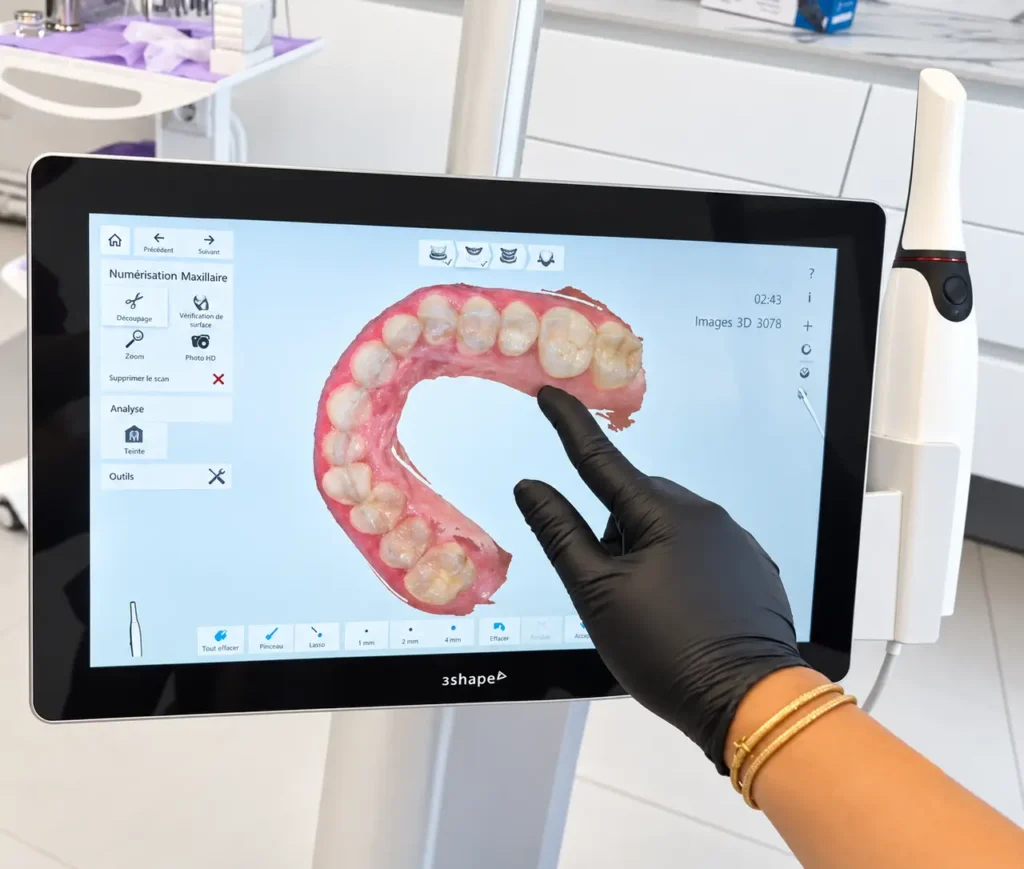 numérisation dentaire iinteractive par scanner intraoral chez SmileHARMONY